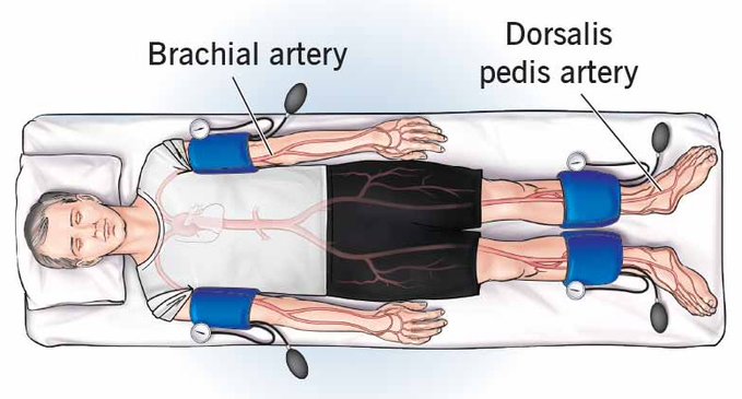 Ankle-Brachial Index