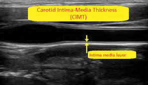 Carotid