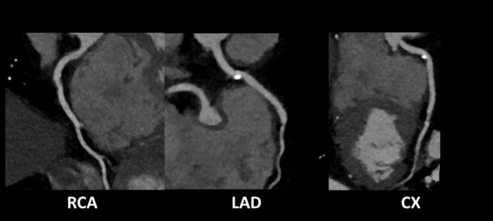 Coronary CT Angiography