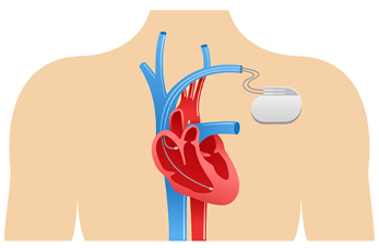 Pacemaker