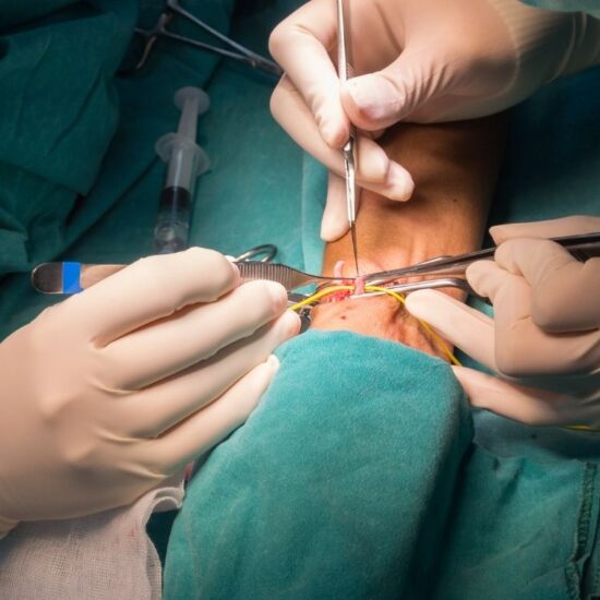 Arteriovenöz Malformasyon