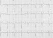 Atriyal Flutter Nedir
