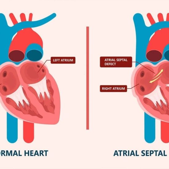 Anjiografik ASDVSDPDAFistül (Doğuştan Kalp Delikleri) Kapama Tedavisi