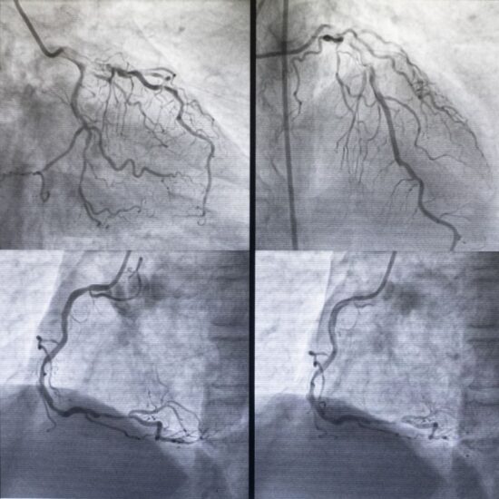 Tanısal Amaçlı Koroner Anjiografi Ne Zaman Gereklidir