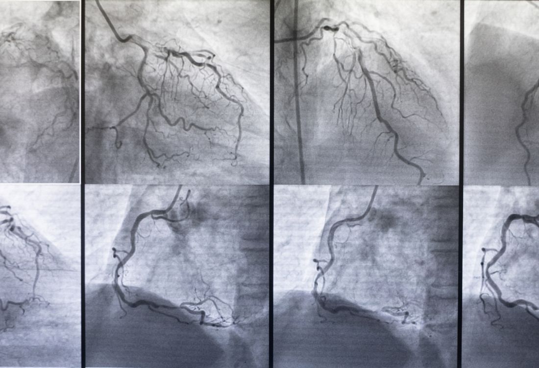 Tanısal Amaçlı Koroner Anjiografi Ne Zaman Gereklidir