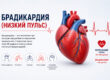 Что такое брадикардия